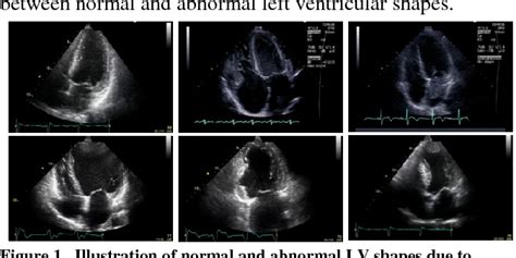 2d lv pw abnormal.